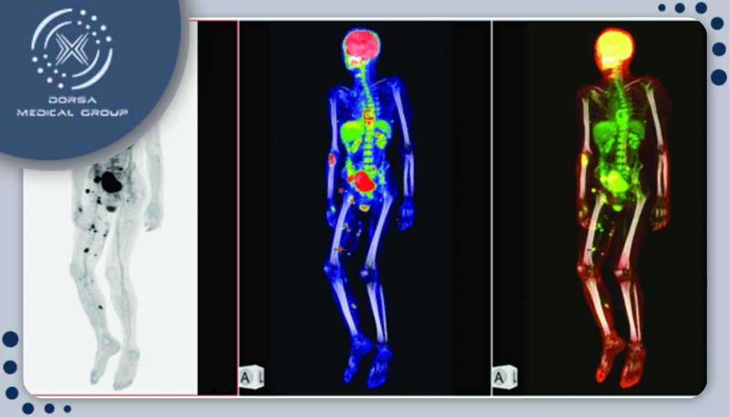 روند انجام Bone nuclear scan